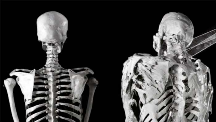 بیماری های ترسناک سندرم مرد سنگی