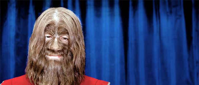 بیماری های ترسناک بیماری هیرسوتیسم شدید